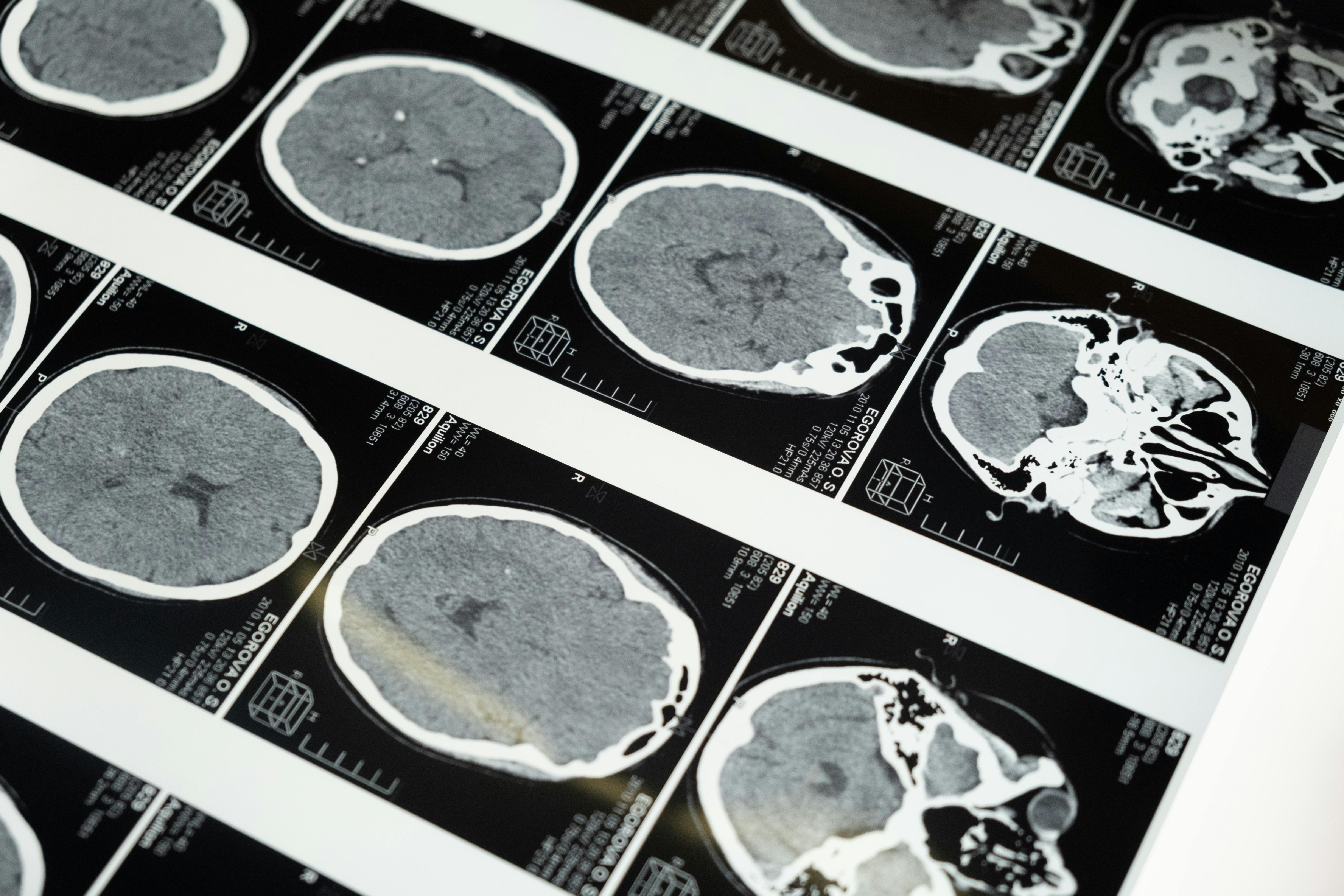 CT brain scan images used in concussion and head injury diagnosis