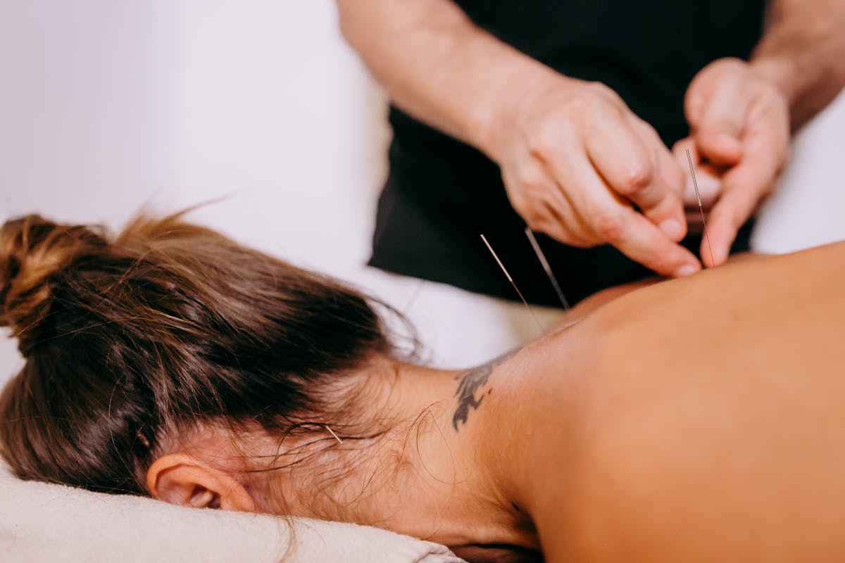 Practitioner inserting fine acupuncture needles along a patient's upper back